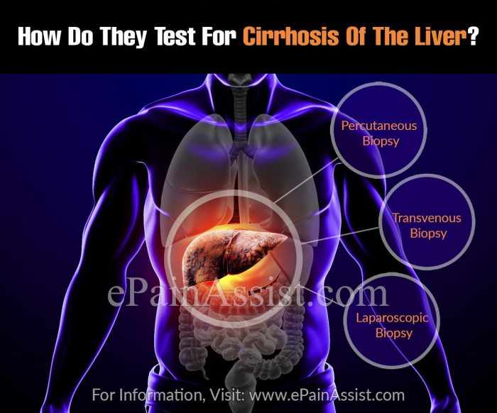 Do i have cirrhosis quiz